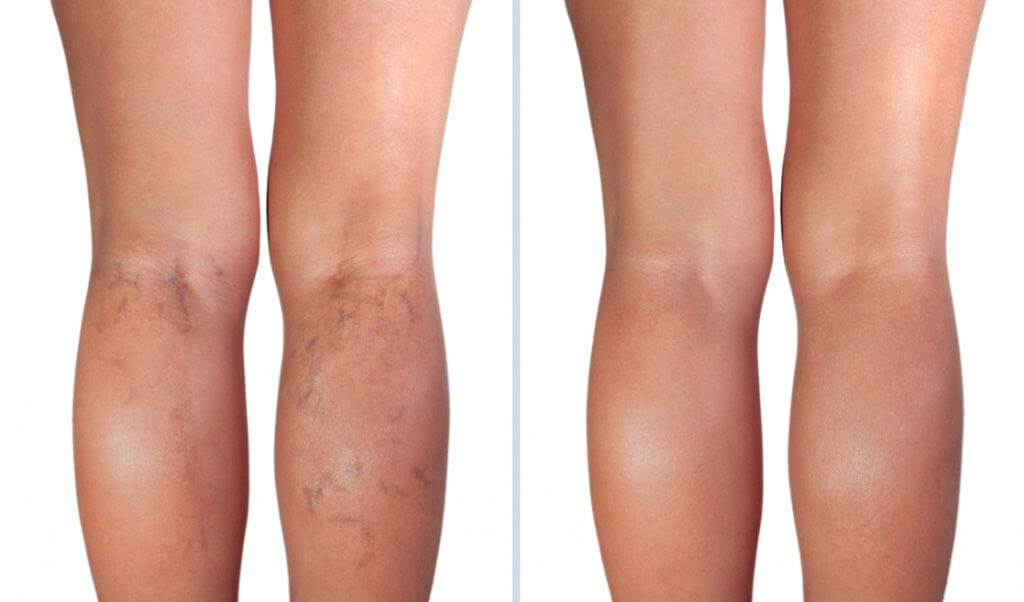 Piernas con várices y sin várices